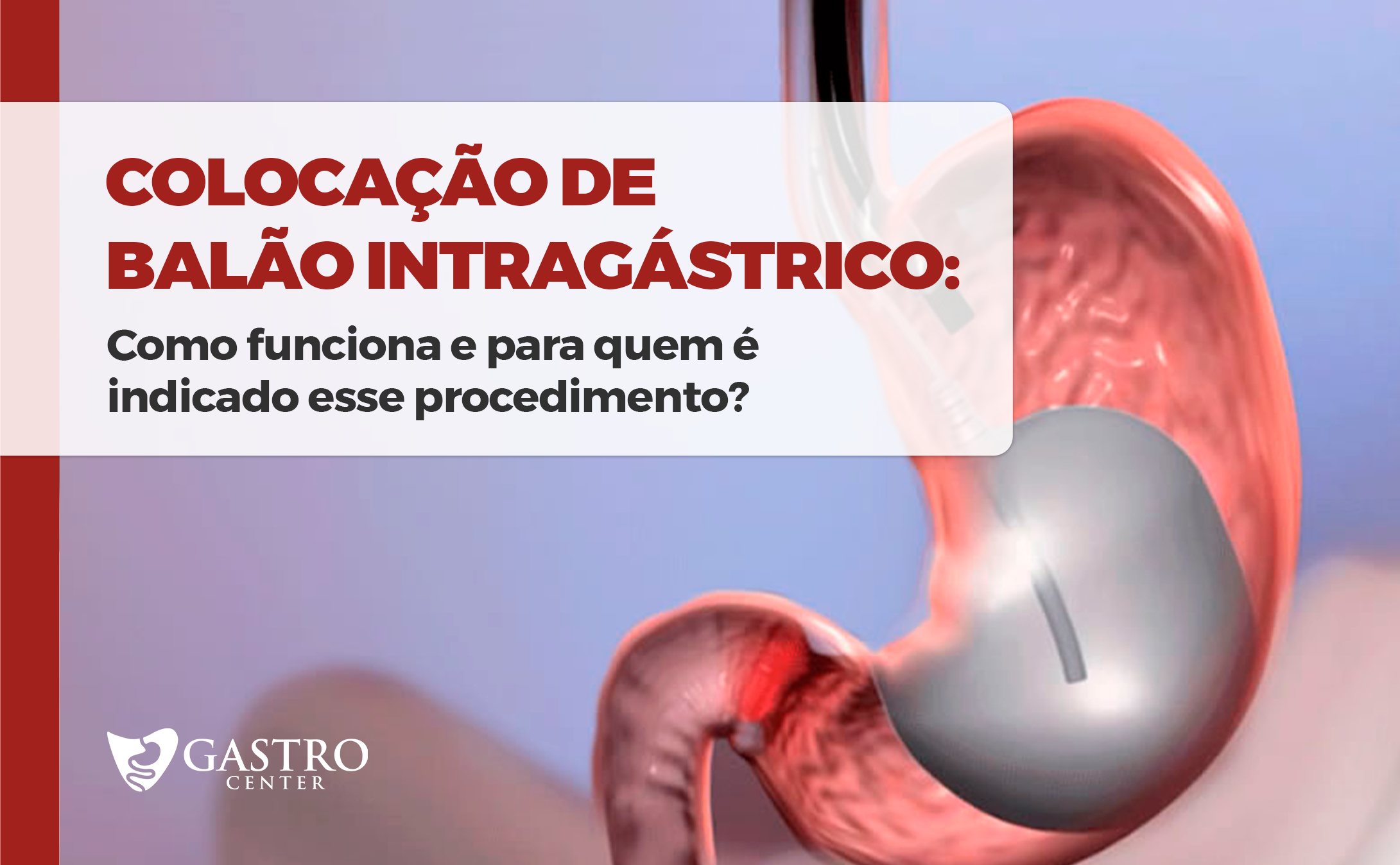 Colocação de balão intragástrico: como funciona e para quem é indicado ...